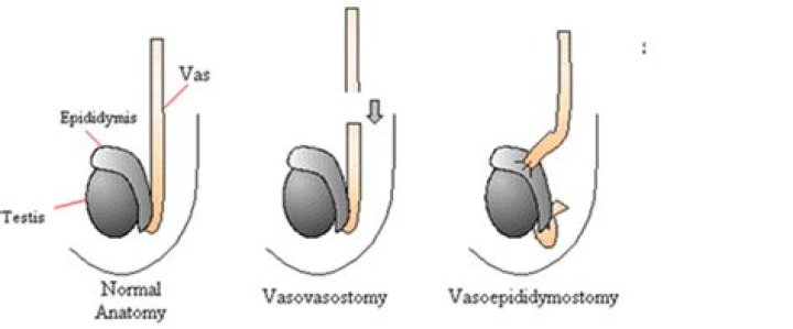Are vasectomies reversible