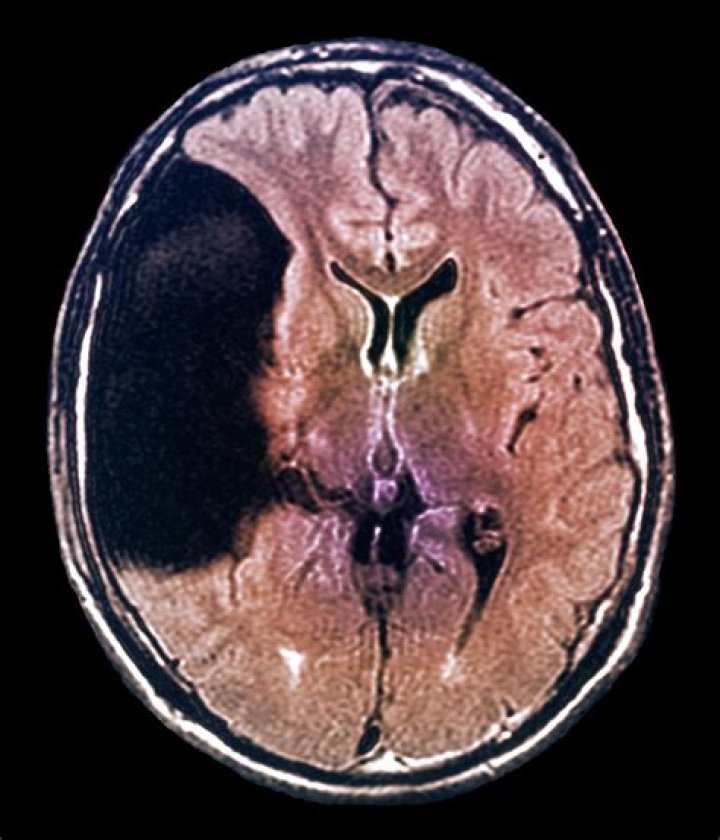 Can arachnoid cyst cause seizures