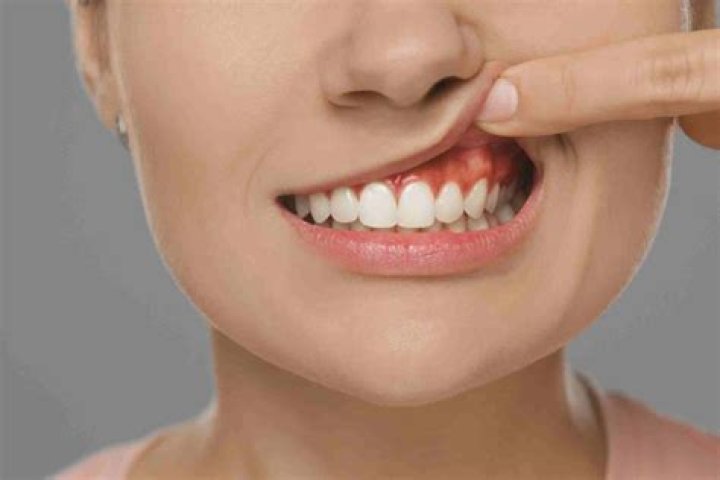 Can bone stick out of gum