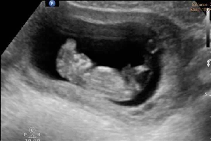Can dwarfism be detected on ultrasound
