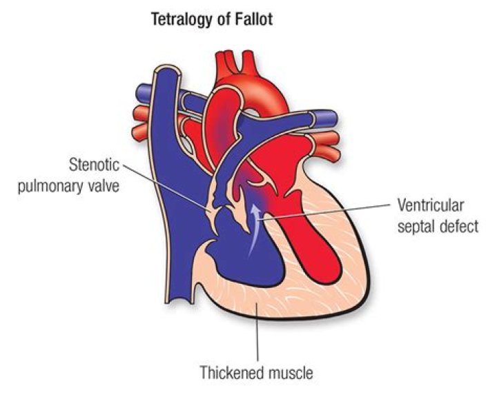 Can Tetralogy of Fallot cause heart failure
