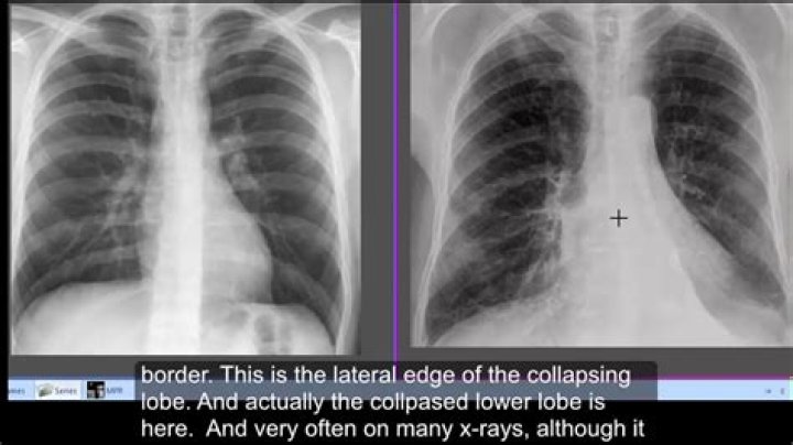 How do you collapse a region in C
