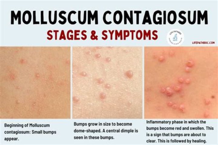 How do you describe molluscum contagiosum