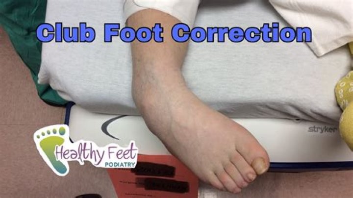 How do you fix clubfoot