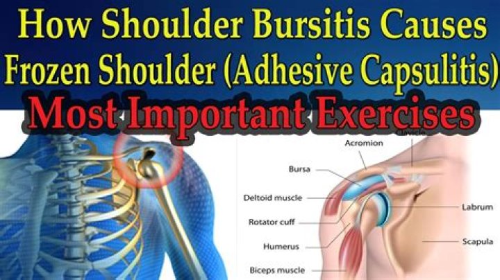 How do you treat bursitis of the scapula