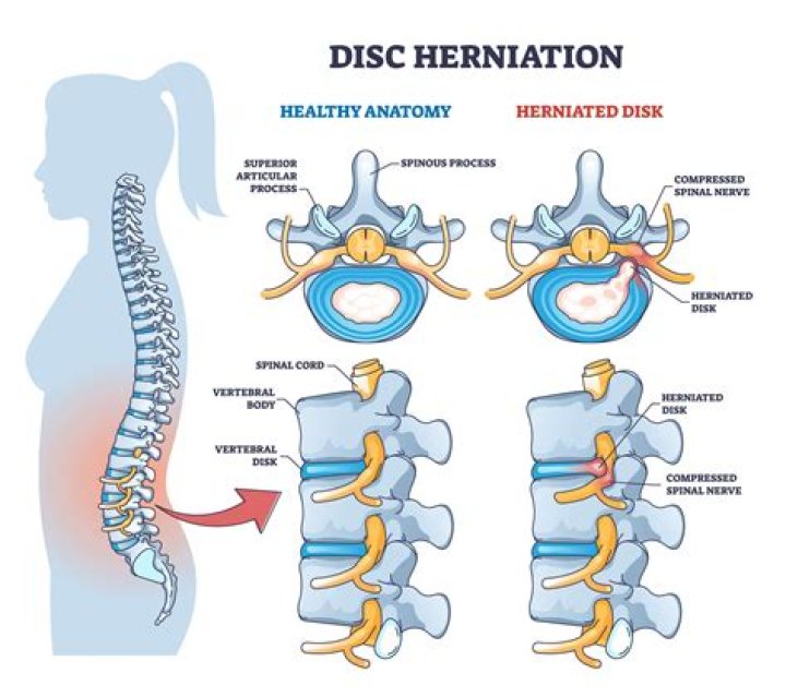 How is lumbar hernia treated