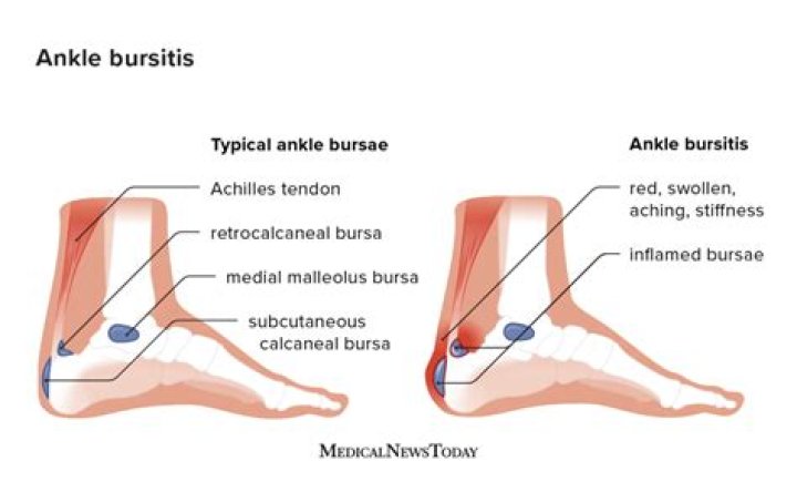 How long does it take for an inflamed bursa to heal