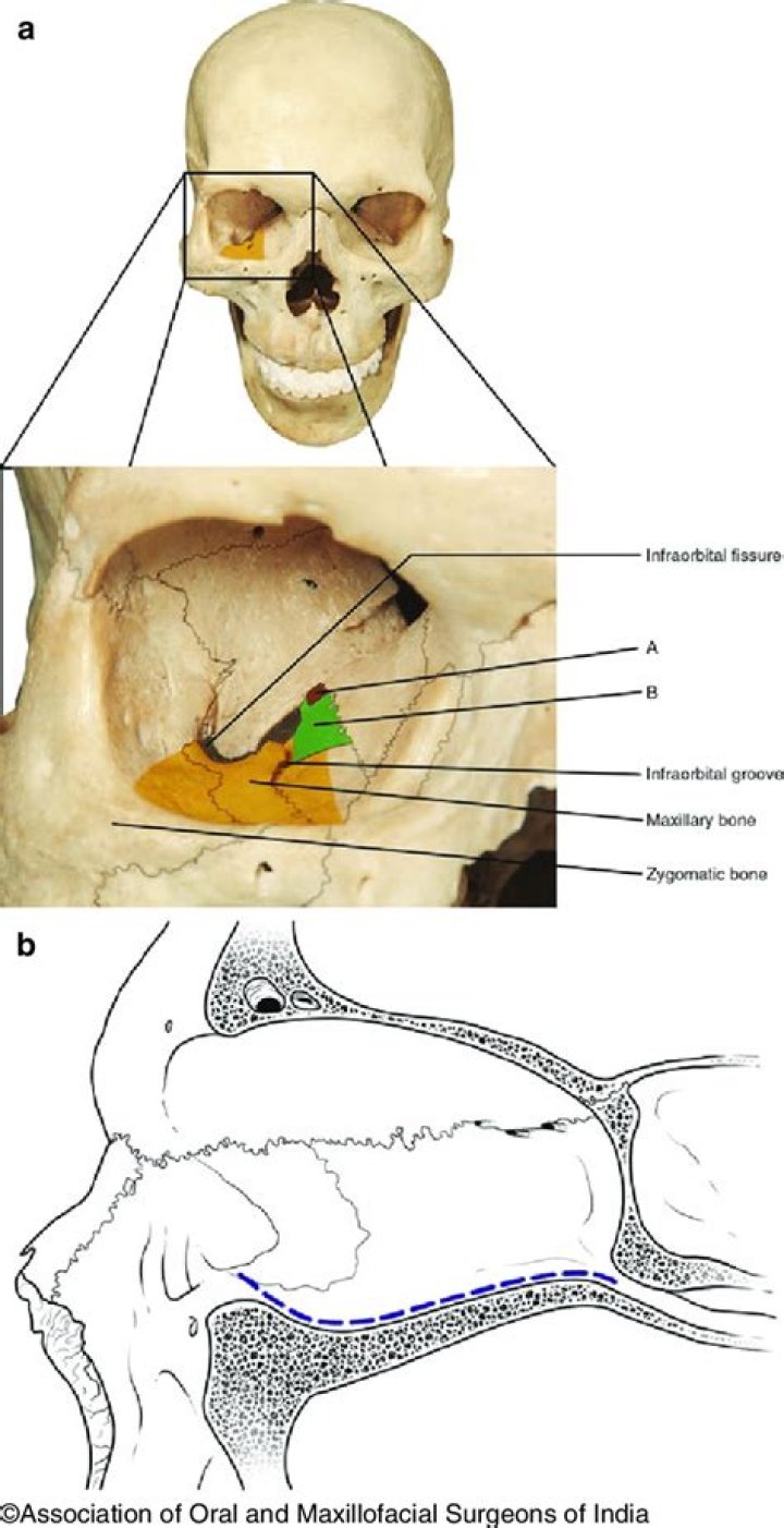 How long does it take for an orbital floor fracture to heal