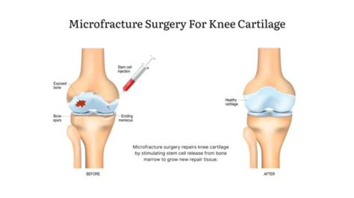 How long does knee microfracture take to heal
