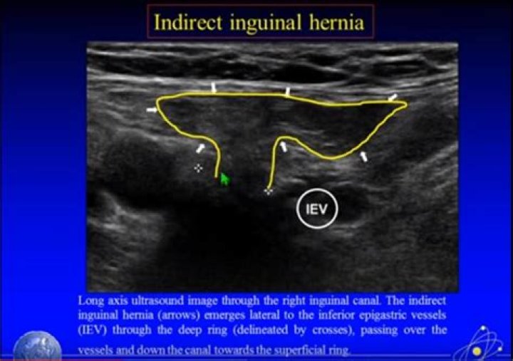 How often do inguinal hernias recur