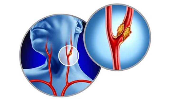 How serious is a blocked artery in the neck