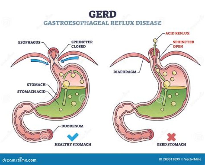Is GERD the same as acid reflux