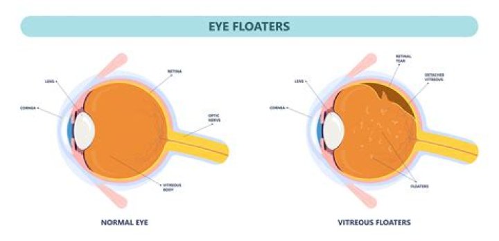 Is vitreous detachment dangerous
