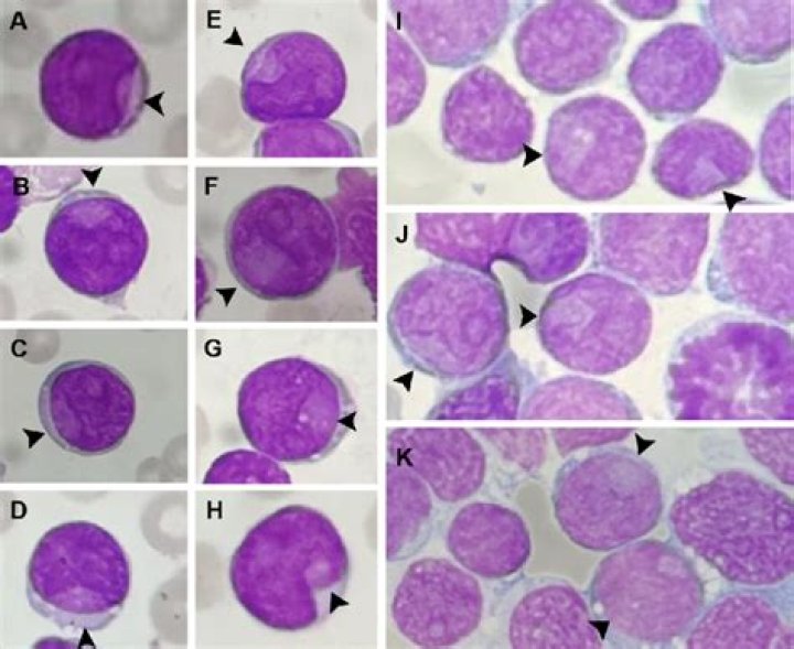 What are blasts in peripheral blood