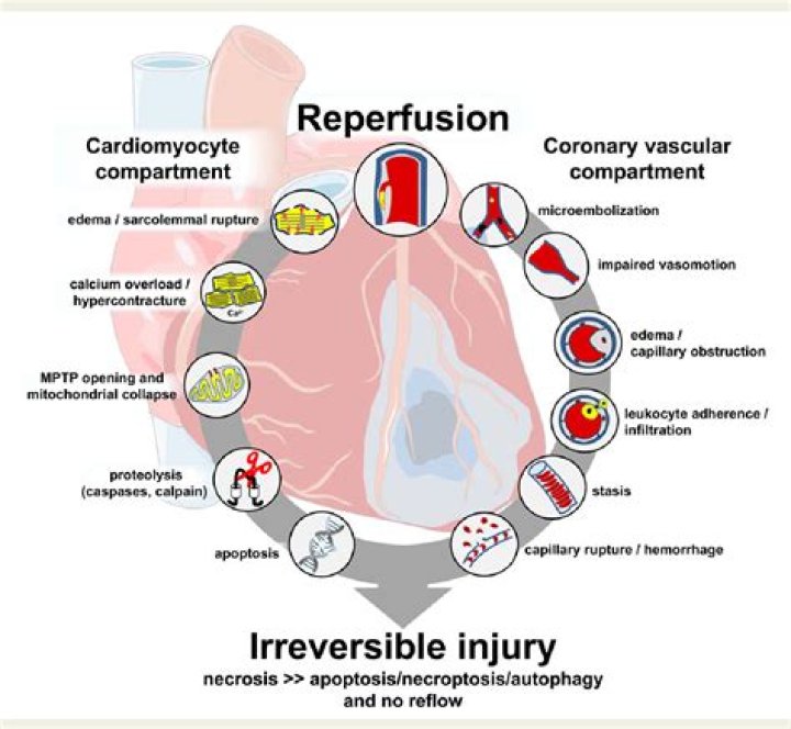 What causes dyspnea in myocardial infarction