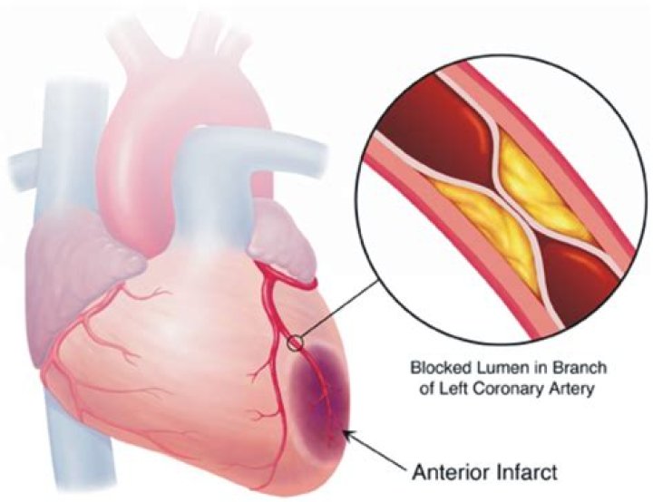 What causes ischemia