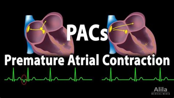 What causes PACs in the heart
