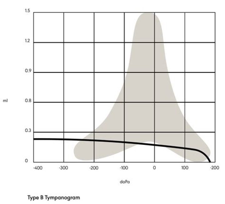 What does Type B Tympanogram mean