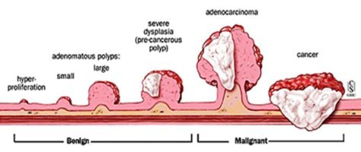 What happens if a polyp is cancerous