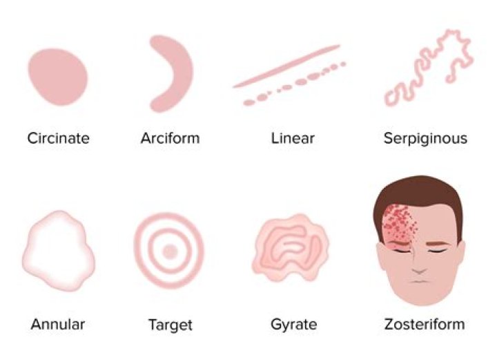 What is a discrete lesion
