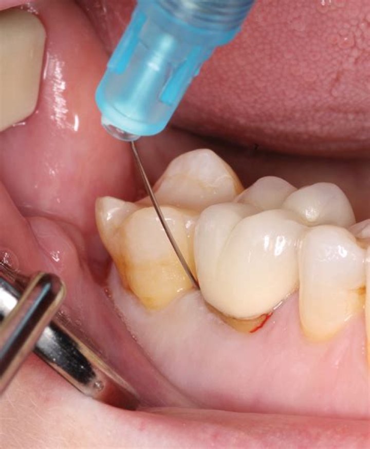 What is a PDL injection