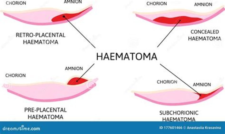 What is a Perigestational hemorrhage