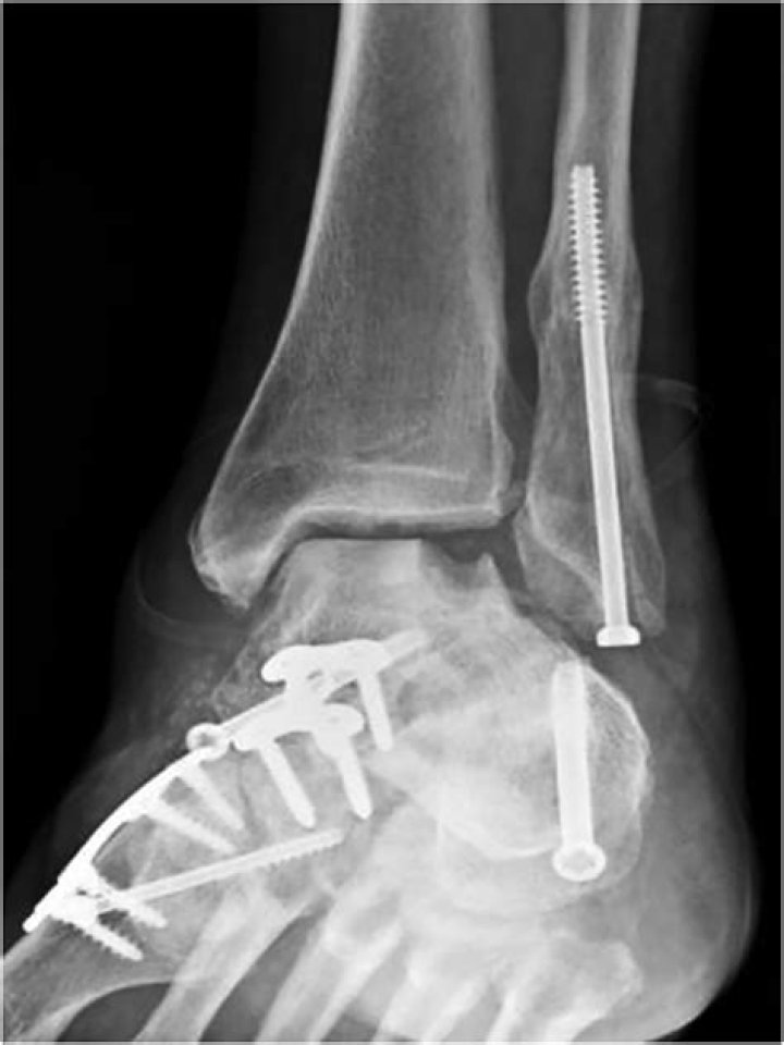 What is a triple arthrodesis of the ankle