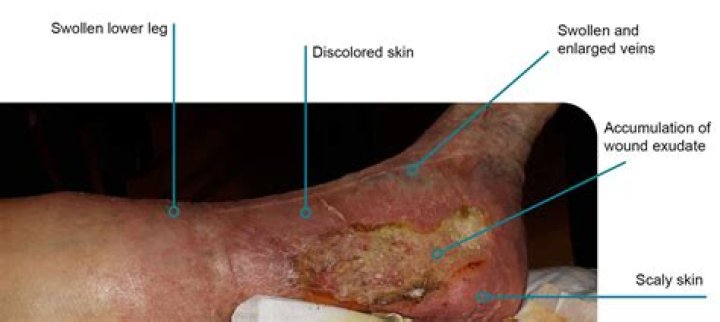 What is a venous skin ulcer