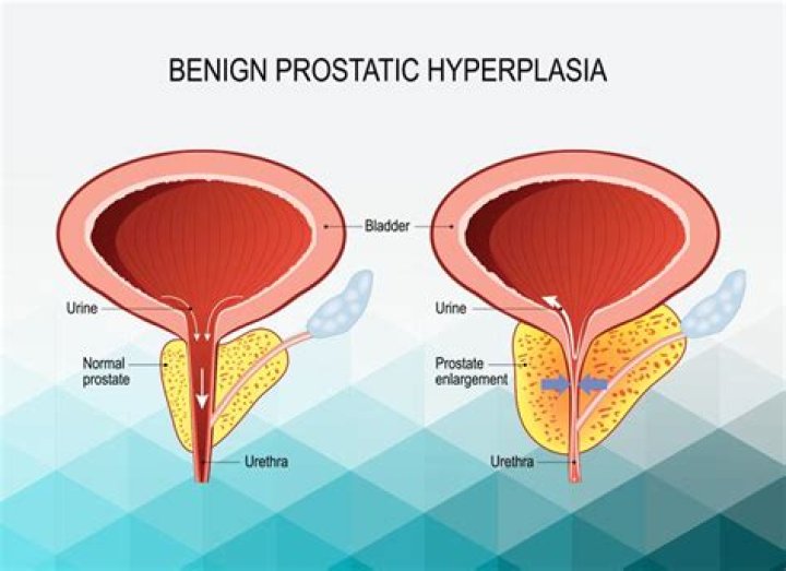 What is BPH medical