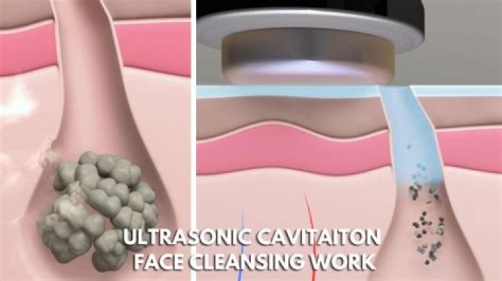 What is cavitation in ultrasonic cleaning
