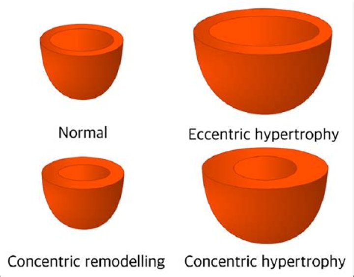 What is concentric remodeling