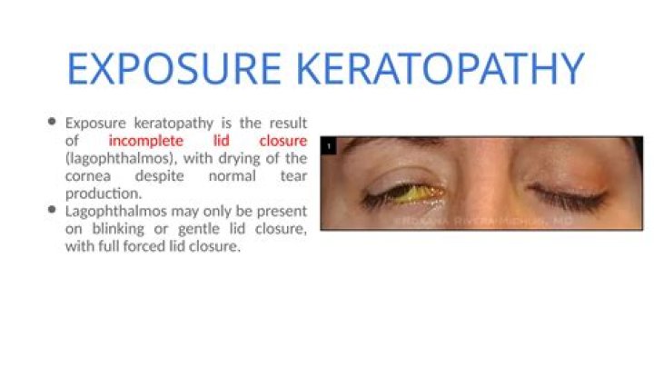 What is exposure Keratopathy