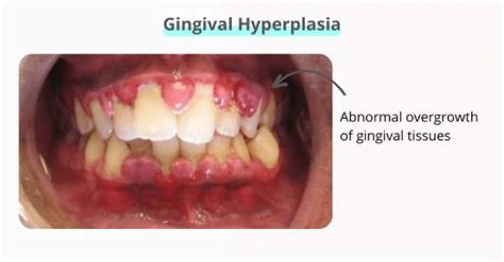 What is gingival hyperplasia