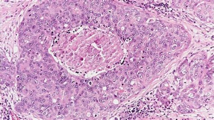 What is high grade ductal carcinoma in situ