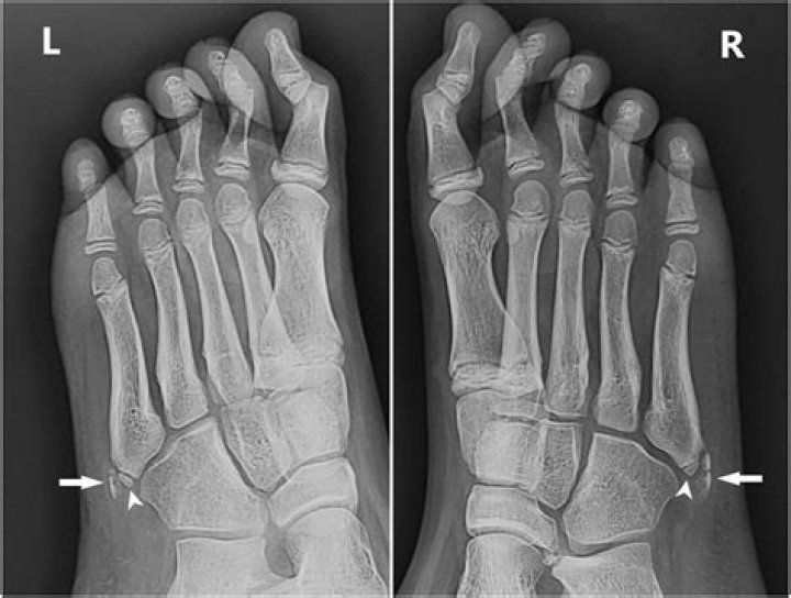 What is Iselin disease