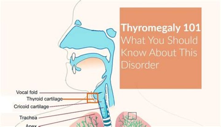 What is mild Thyromegaly