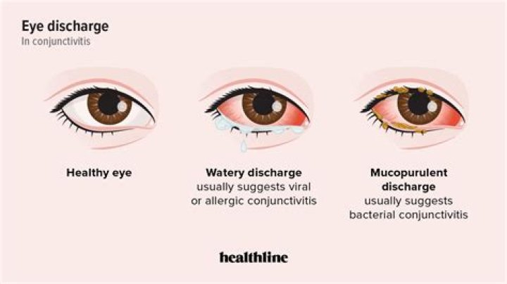 What is Mucopurulent conjunctivitis