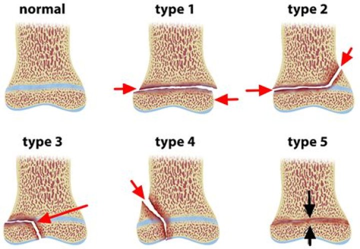 What is open fracture type I or II