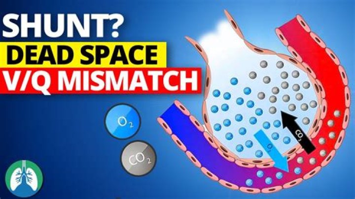 What is the difference between V Q mismatch and shunt