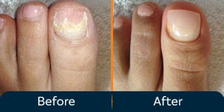 What is the recovery time for toenail removal surgery
