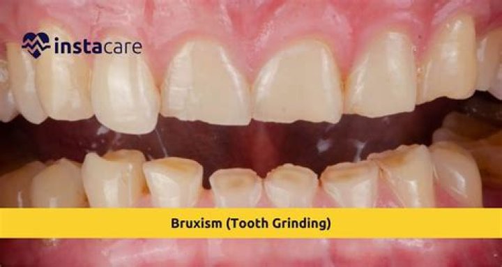 What problems can grinding your teeth cause