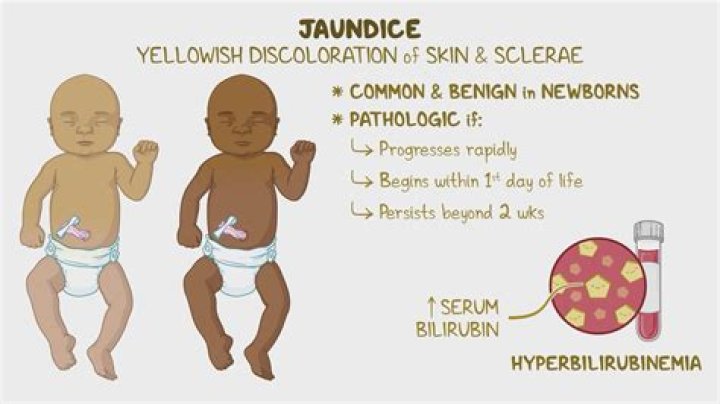 Who discovered cure for jaundice